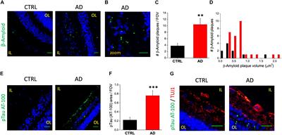 Neuroinflammatory Processes, A1 Astrocyte Activation and Protein Aggregation in the Retina of Alzheimer’s Disease Patients, Possible Biomarkers for Early Diagnosis